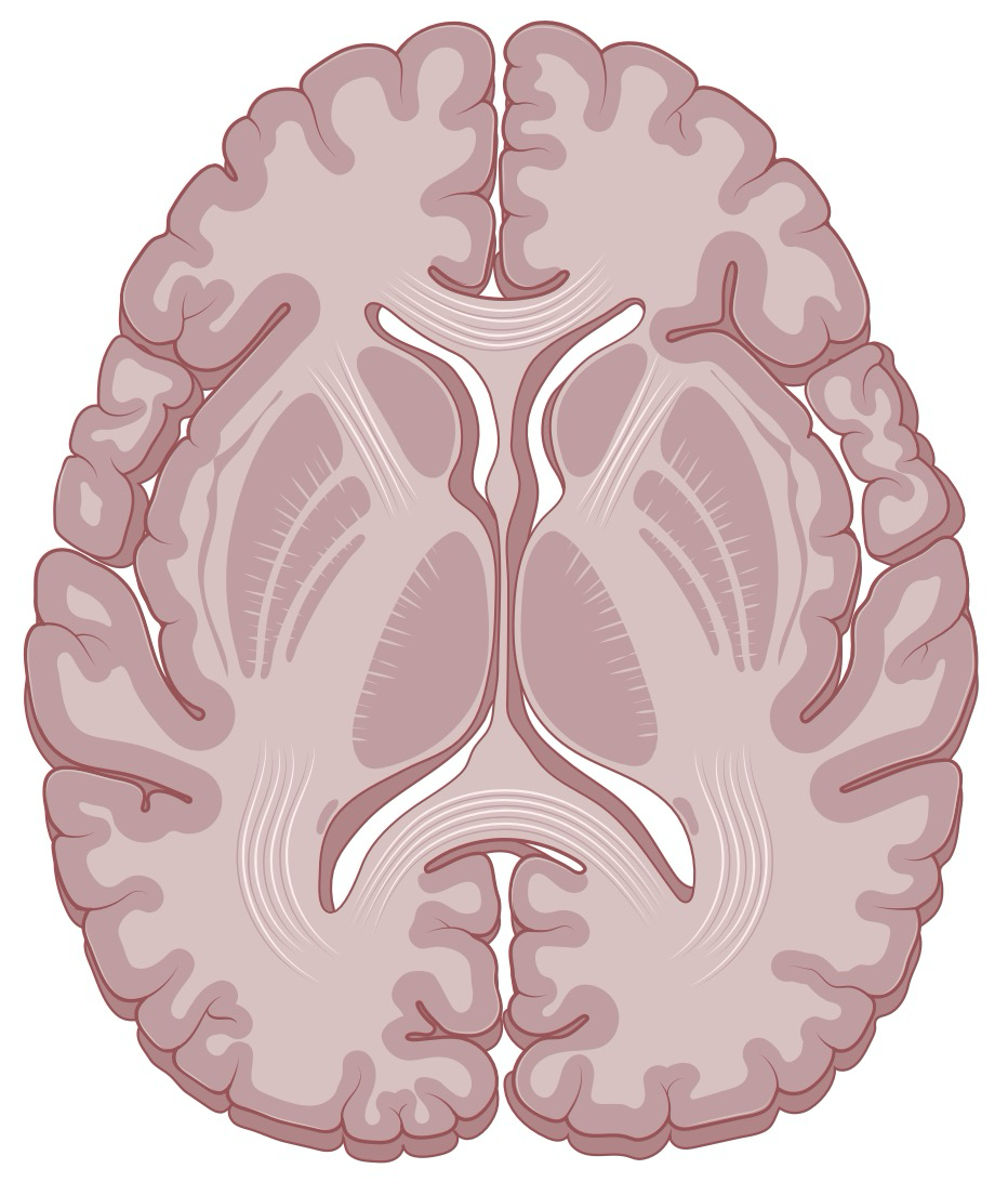 Glioma