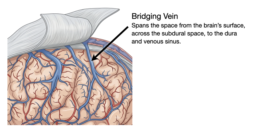 A closer view of that bridging vein at the exact point where it crosses into the dural sinus.